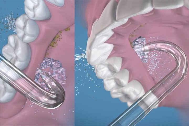 limpeza de prótese protocolo com irrigador