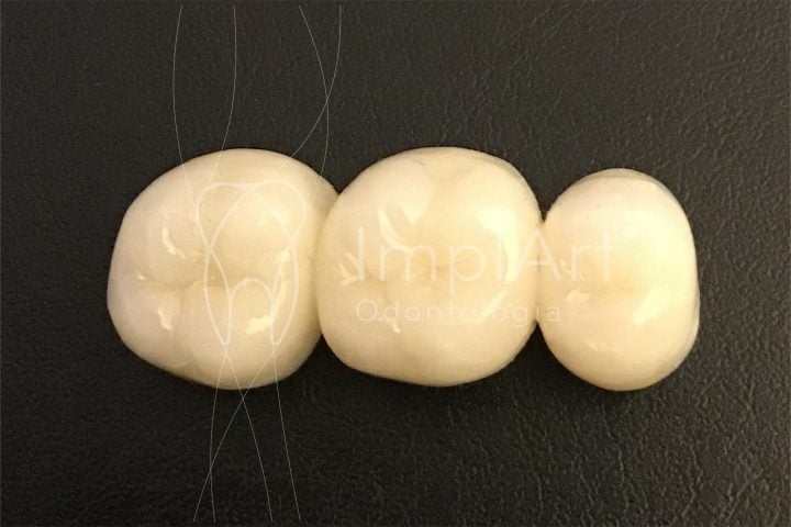 ponte de zirconia sem metal posterior 49kb