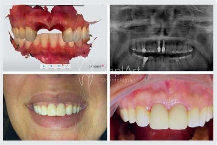 implante dentes da frente 50kb