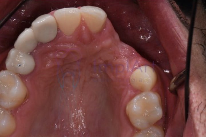 falta de dentes leva a perda óssea