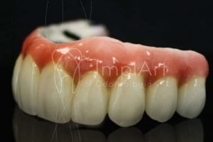 como é feito um implante dentário 31