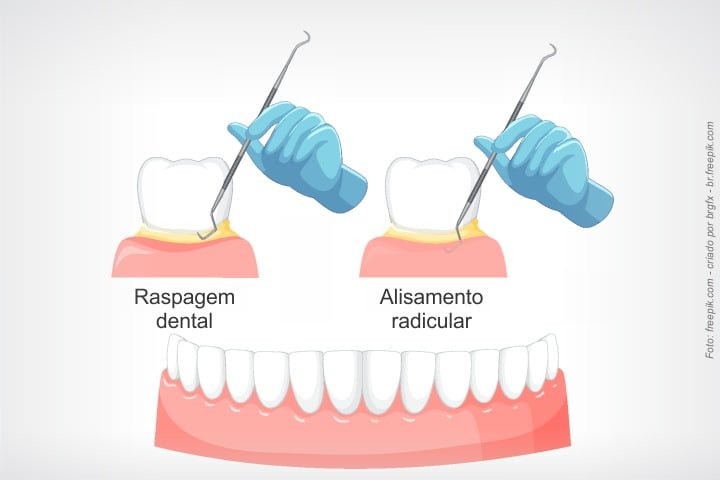 raspagem radicular é um tratamento para doença periodontal