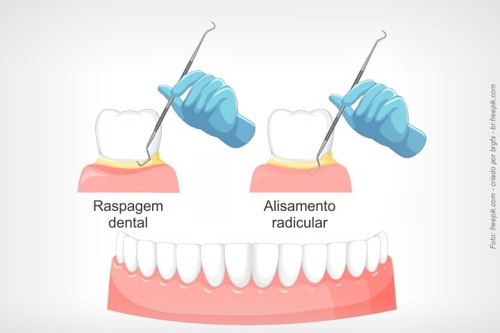 raspagem dentária