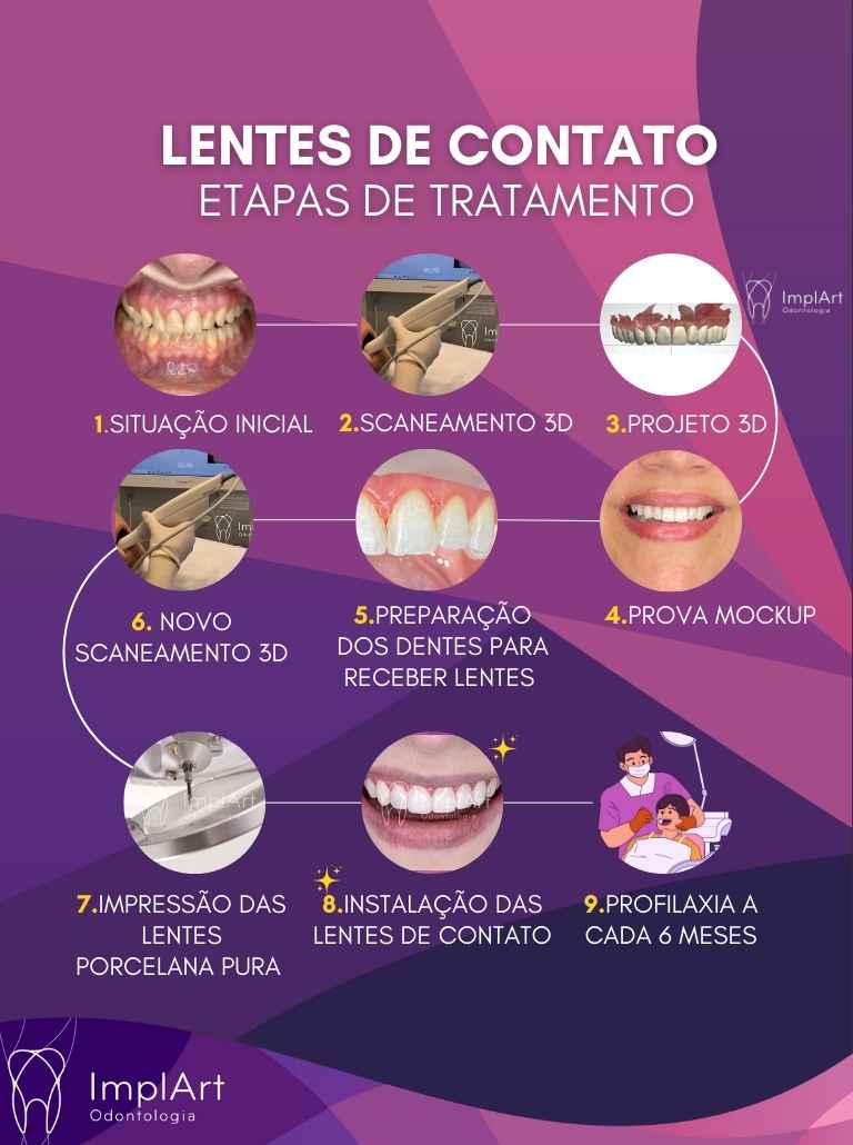 lentes de contato dentais