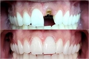 como é feito um implante dentário 46