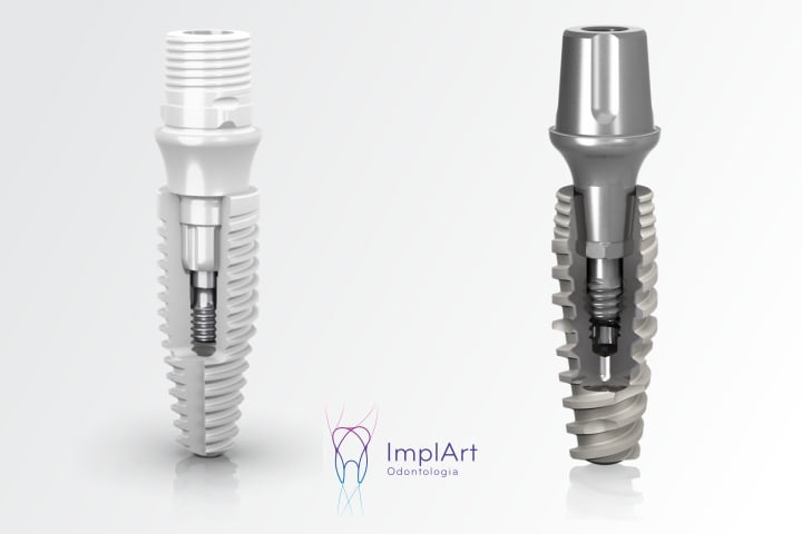 implantes dentários mais modernos