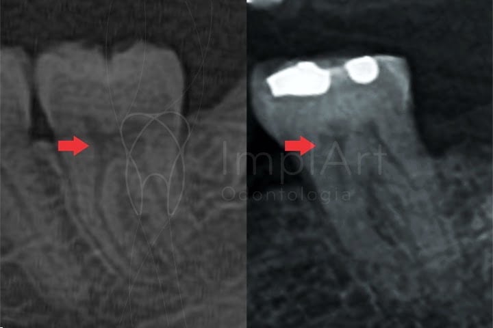 comparacao dente jovem dente idoso 50kb