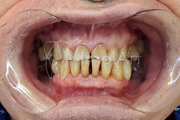 desgaste margem incisal fratura retracao gengival 49kb