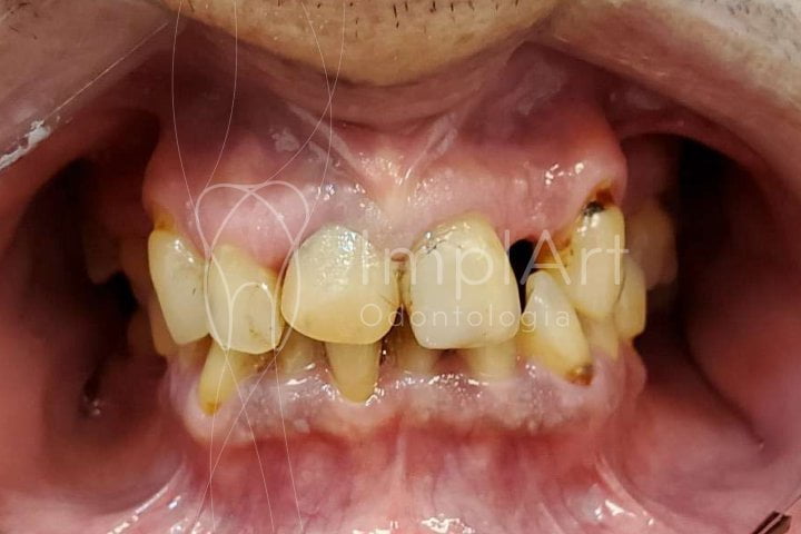 movimentacao dos dentes idade 50kb