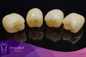 More translucent and resistant cubic zirconia crowns coroa de zirconia cubica