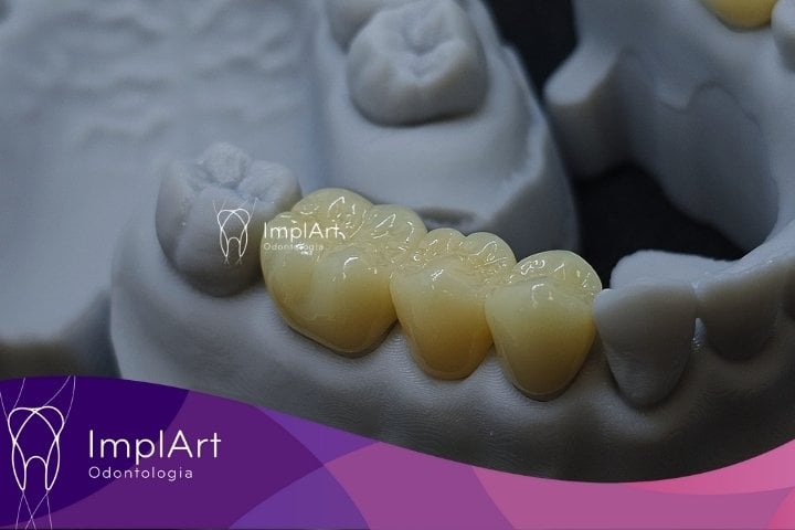 coroa de zirconia