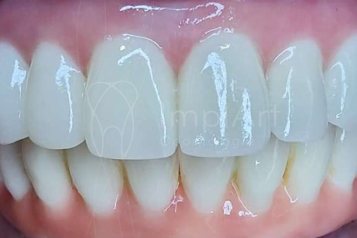 protocolo superior inferior protese porcelana zirconia 50kb