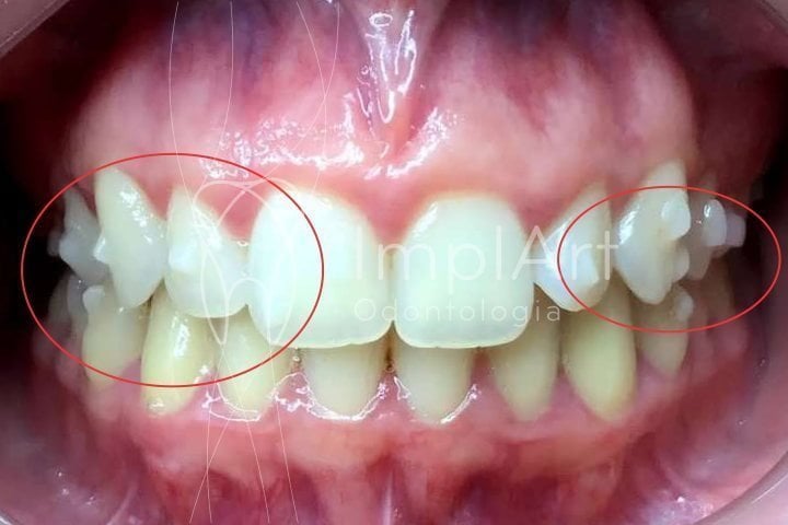 attachments invisalign 50kb