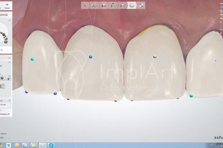 projetanto lentes dentais de porcelana 50kb