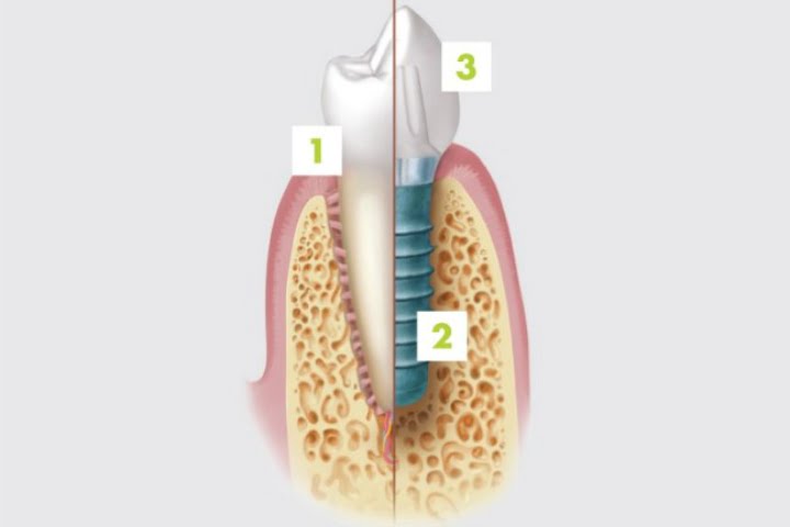 comparacao entre implante e dente natural 49kb