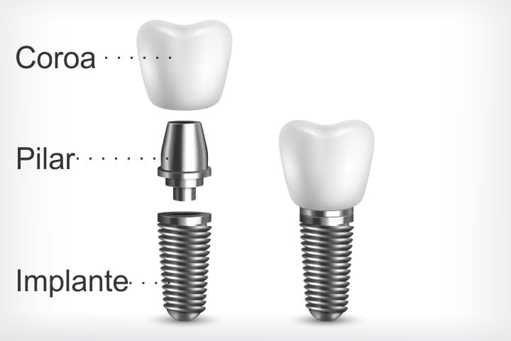 coroa pilar implante 50kb