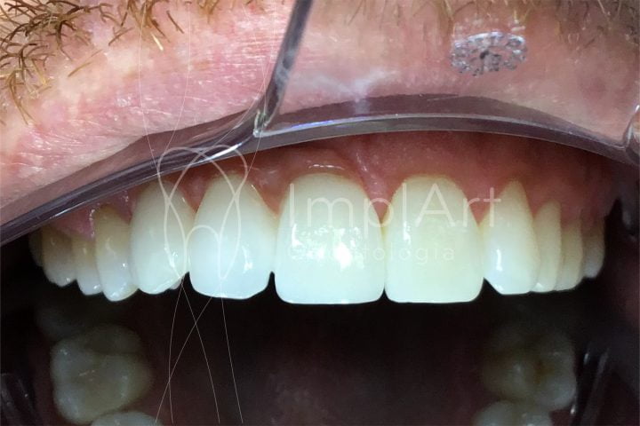 diferenças entre implantes dentários e dentes naturais