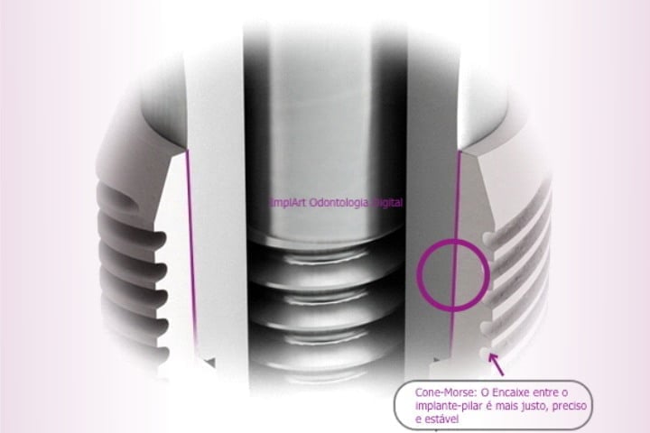 implante cone morse 50kb