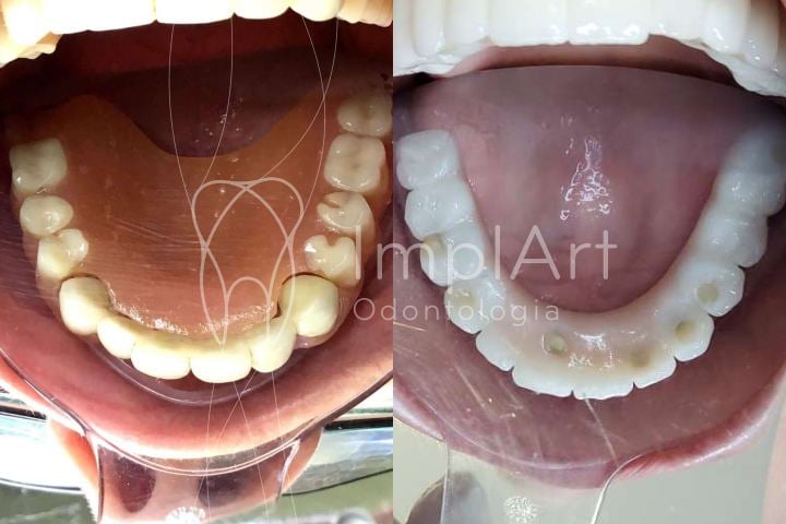 ceu da boca livre com troca de protese movel por implantes dentarios e protese de zirconia