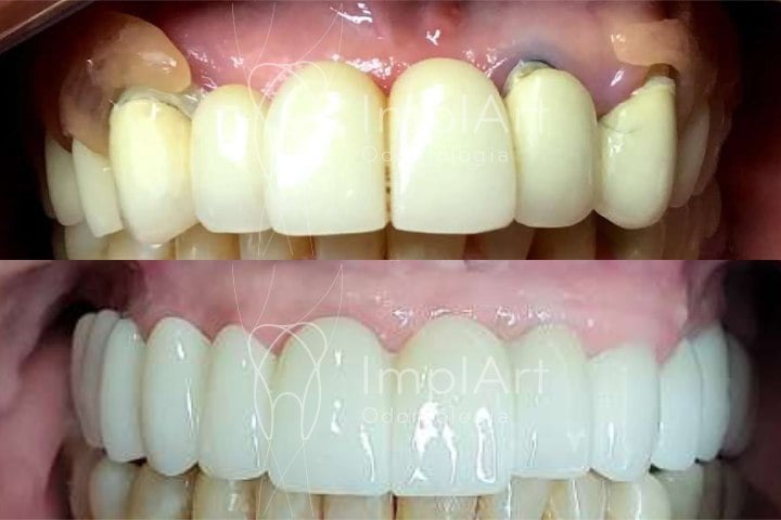 implante protese zirconia total antes e depois 50kb 1