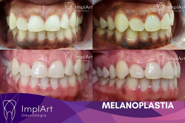 melanoplastia