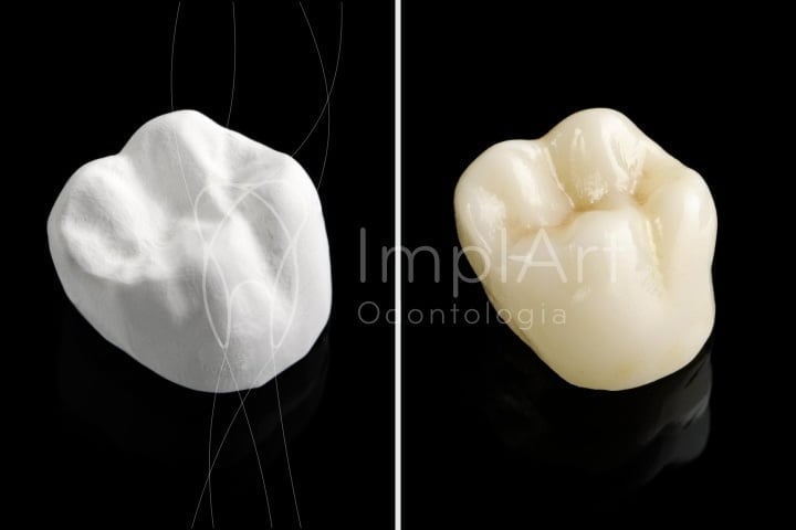 coroa zirconia aplicada 50kb