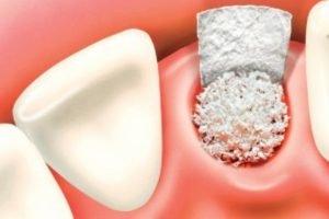 enxerto osseo apos extracao dente 50kb