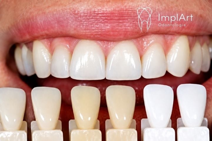 Como é feita a escolha da cor dos dentes na prótese ? escala de cores dos dentes