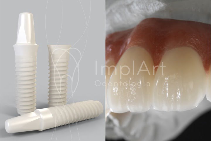 implantes ceramicos coroas zirconia pura 50kb