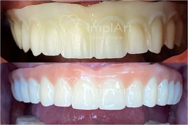 protese total zirconia aplicada 50kb