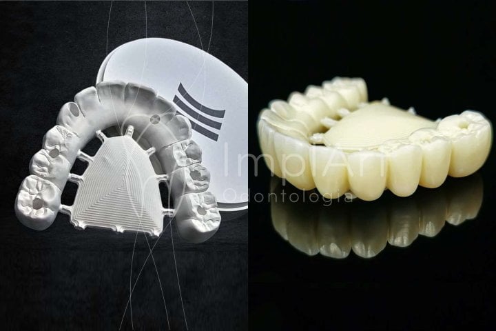 protese zirconia pura antes e depois 50kb