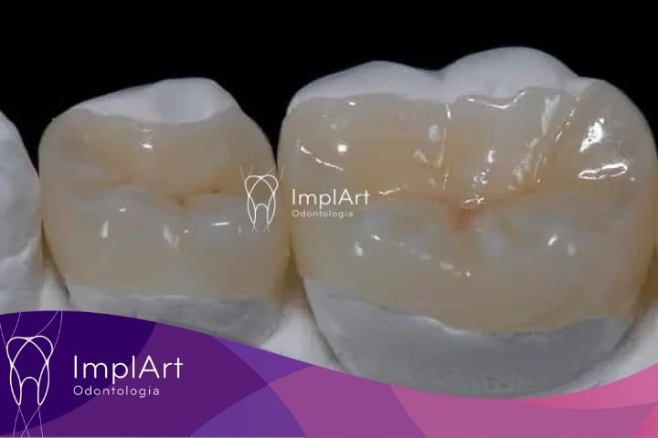 bloco de porcelana - onlay