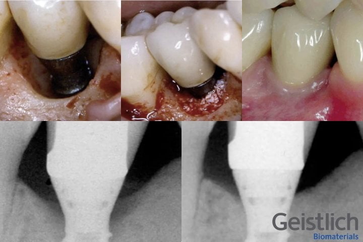 enxerto peri implantite periimplantite50kb