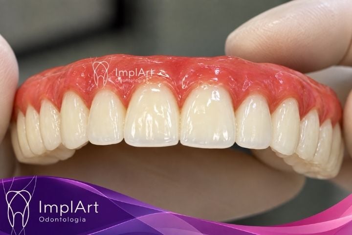 protese protocolo com implantes
