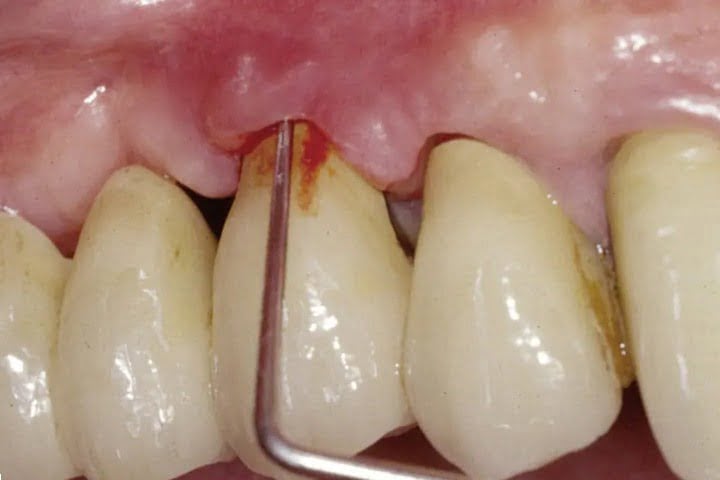 sondagem de implante com periimplantite 50kb