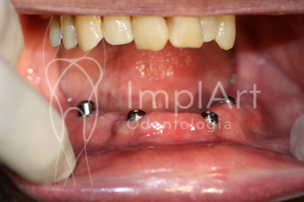 Reabilitacao total do maxilar inferior com 4 implantes All 5246734305 l