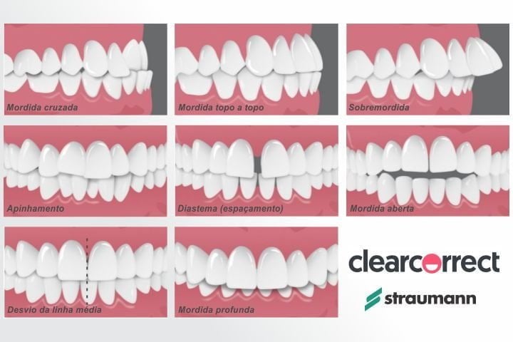 straumann clearcorrect indicacoes 50kb