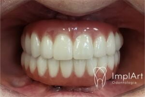 PROTESE PROTOCOLO ZIRCONIA SUPERIOR E INFERIOR SITE