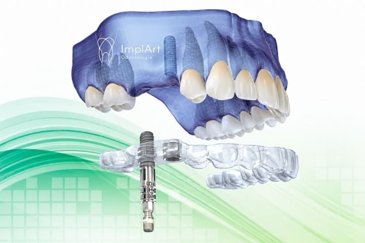 GUIA CIR&Uacute;RGICO PARA IMPLANTE DENTARIO SEM CORTES