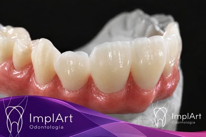 coroa dentaria clinica implart