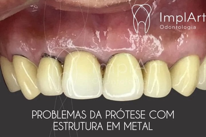 coroa dentaria metalo-ceramica