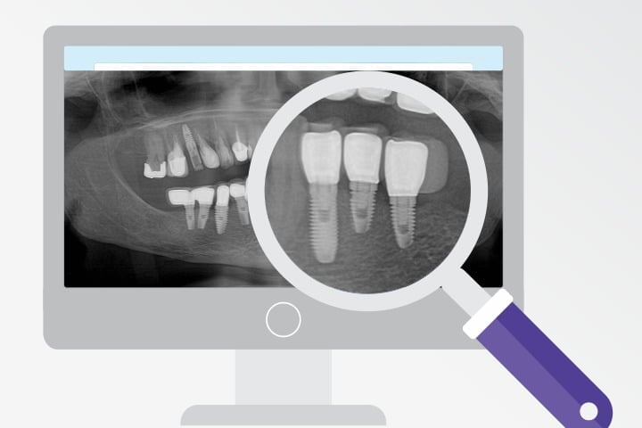 manutenção de implantes dentários