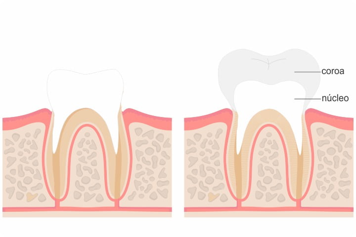 núcleo e coroa dentária