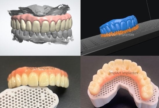 protese protocolo de branemark 3D