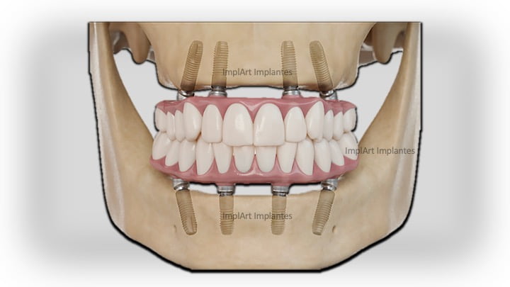 protese protocolo sobre implante dentário total