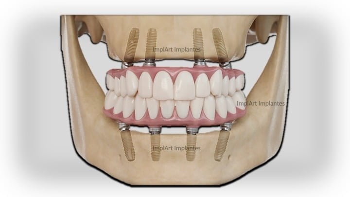 protese protocolo sobre implante total 
