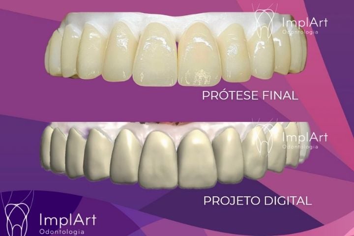 zirconia com dentes individuais projeto digital