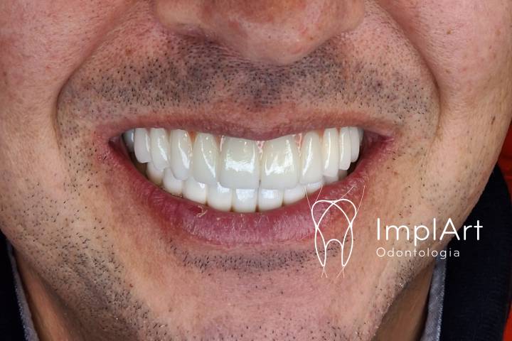 implante dentario e PROTESE PROTOCOLO pode ajudar a rejuvenescer 