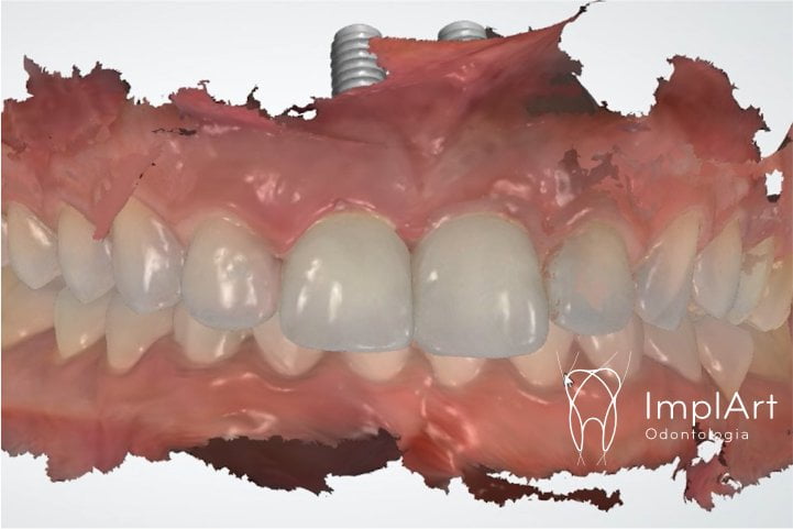 planejamento CADCAM implante dentario dente da frente