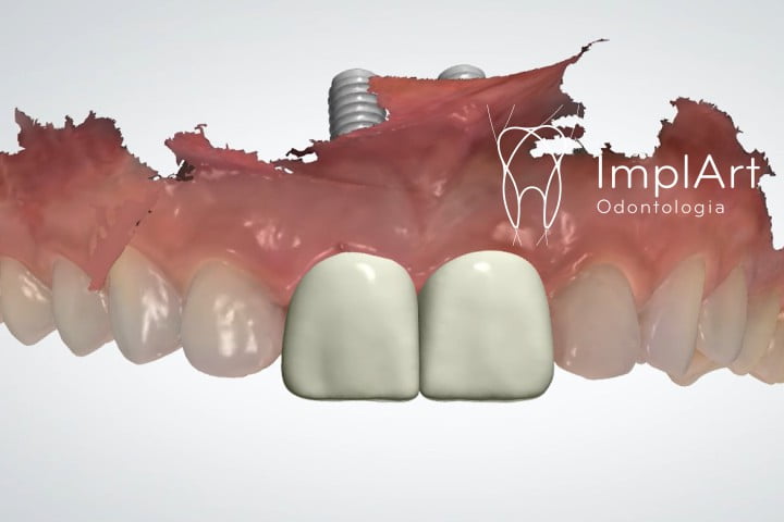 planejamento digital coroa de implante dentario dente da frente 